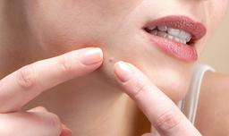 Có nên nặn mụn hay không? Tại sao?