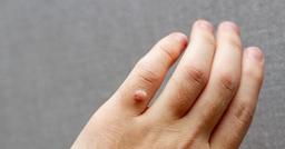 Bật mí cách trị mụn cơm hữu hiệu