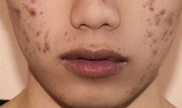 Nên ăn gì để hết thâm mụn hiệu quả?