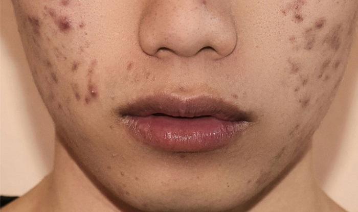 Nên ăn gì để hết thâm mụn hiệu quả?