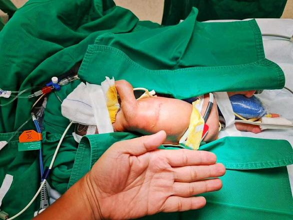 Phẫu thuật cho bé gái sinh non đa dị tật khi mới 2 ngày tuổi