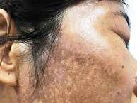 Da mặt thành “bánh đa vừng đen” vì bôi kem trộn làm trắng không rõ nguồn ốc