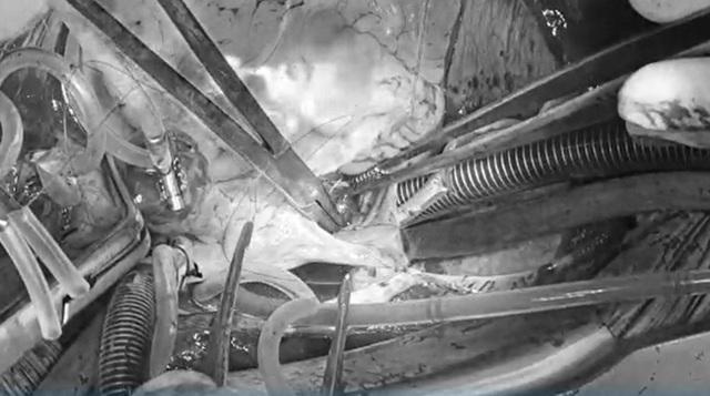 Người đàn ông nghĩ mình say cà phê không ngờ bị khối u trong tim