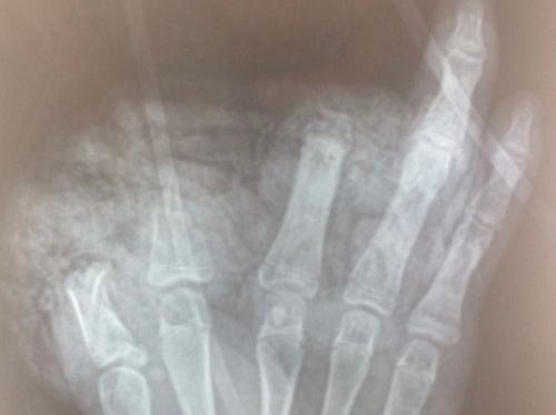 Mày mò chế tạo theo youtuber, nam sinh cụt 3 ngón tay vì quả pin phát nổ