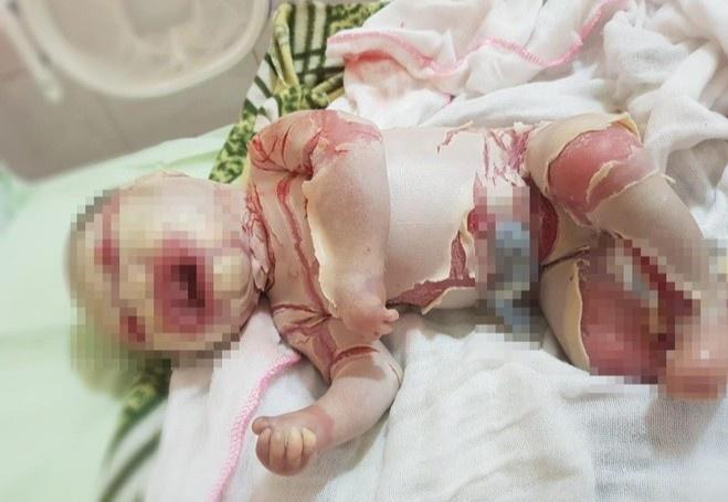 Bé sơ sinh có lớp da vảy cá ở Hà Giang được xuất viện