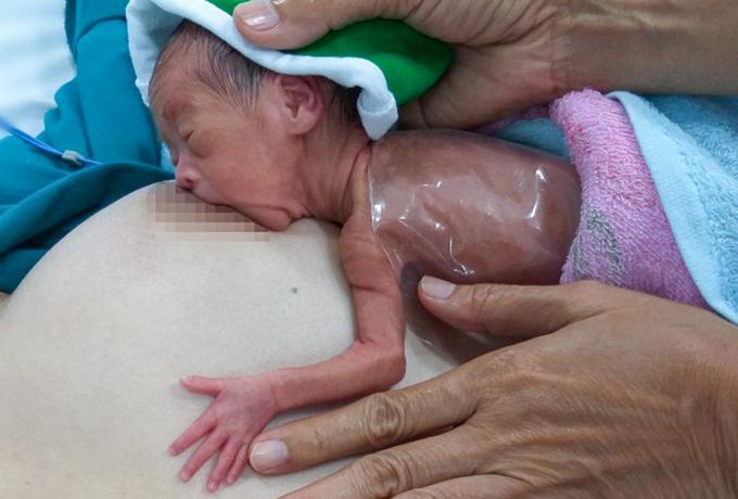 Nuôi sống bé sinh non nhỏ như con chuột bằng cách "ấp" trên da mẹ 24/24h