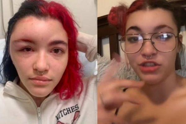 Cô gái tự nhuộm tóc khiến gương mặt biến dạng, sưng húp: Nên làm gì để không đi vào vết xe đổ?