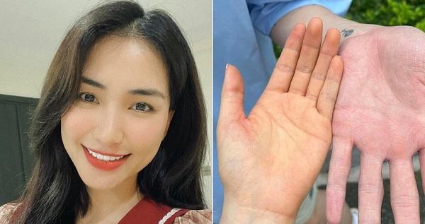 Làm mẹ bỉm, Hòa Minzy hết bị rạn bụng lại lo lắng khi bị vàng da tay