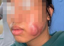 Tạo má lúm đồng tiền làm duyên ở cơ sở không uy tín, thiếu nữ 16 tuổi bị sưng vù mặt