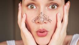Bạn có nên nặn mụn đầu đen không? Tại sao?