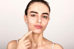 Cách trị mụn quanh miệng hiệu quả, an toàn