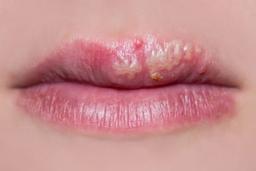 Cách trị mụn nước ở môi nhanh chóng, an toàn