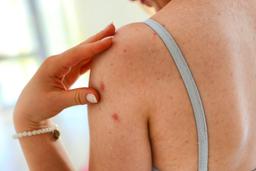 Cách để bạn thoát khỏi mụn lưng một lần và mãi mãi