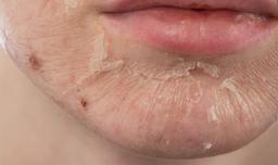 Tình trạng lột da là gì? Nguyên nhân và cách điều trị hiệu quả