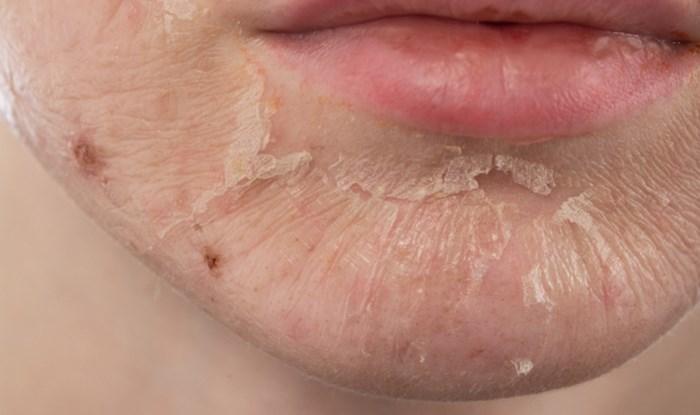 Tình trạng lột da là gì? Nguyên nhân và cách điều trị hiệu quả