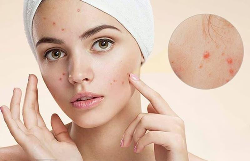 Ưu và nhược điểm của việc sử dụng Hydrogen Peroxide trị mụn