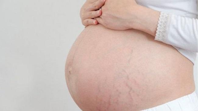 Rạn da khi mang thai: Nguyên nhân và cách phòng ngừa