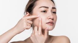 Mụn đầu trắng: Nguyên nhân và các biện pháp phòng ngừa