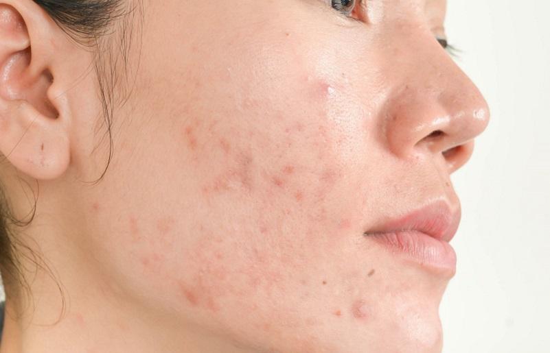 Cách trị mụn viêm hiệu quả: Những điều bạn không thể bỏ qua