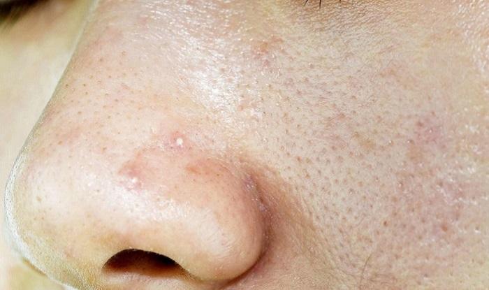 Bật mí cách chăm sóc da dầu mụn lỗ chân lông to hiệu quả nhất