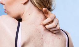 5 cách trị mụn lưng hiệu quả từ chuyên gia da liễu