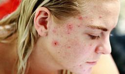 Cách trị mụn nội tiết tố bằng cách điều chỉnh chế độ ăn uống