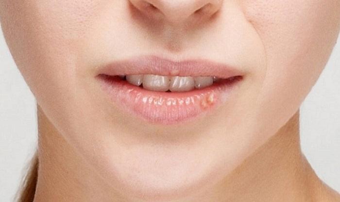 Môi xinh mọc mụn: Đâu là cách trị mụn ở môi nhanh nhất