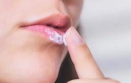 Bật mí cách trị mụn rộp ở môi cho đôi môi xinh tươi