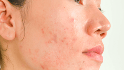Bỏ túi những cách trị mụn viêm sưng đỏ cực kỳ hiệu quả