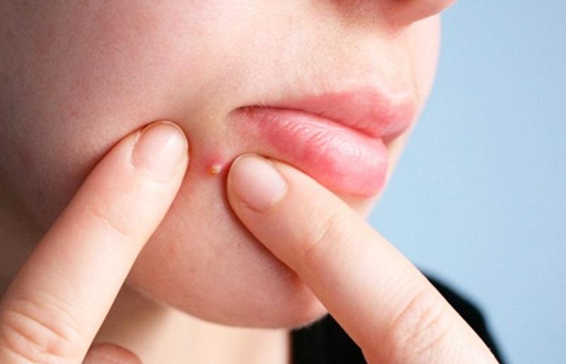 Có nên nặn mụn mủ không và lời giải đáp từ chuyên gia