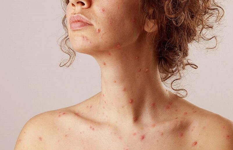 Mẹo nhỏ giúp bạn chăm sóc da sau khi bị thủy đậu