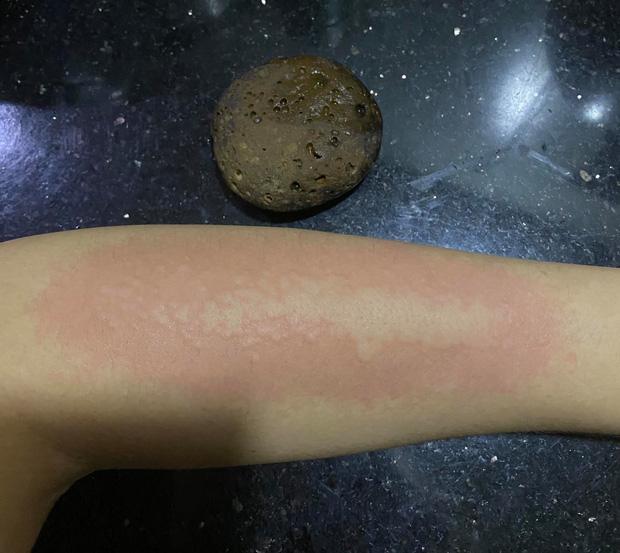 Cô gái bị dị ứng và bong da do tẩy da chết bằng đá