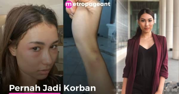 Hoa hậu Hoàn vũ Indonesia bị bỏng mặt do làm da tại viện thẩm mỹ