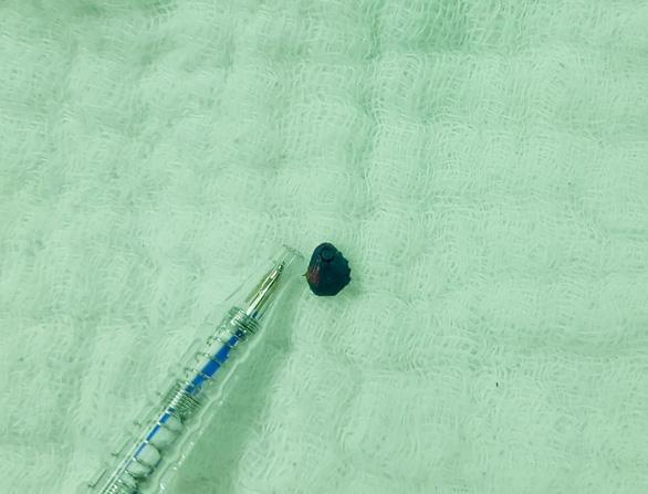 Quảng Nam: Học sinh lớp 1 bị bạn nhét đất sét vào tai đến điếc