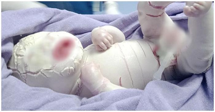 Thêm 1 bé sơ sinh ở Hà Giang chào đời với lớp da vảy cá