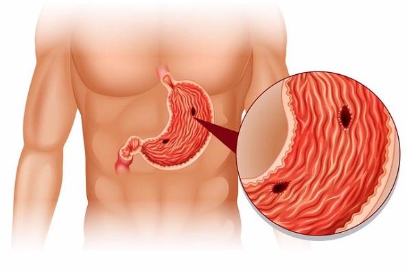 Quảng Ninh: Bé trai 11 tuổi bị thủng dạ dày do hay ăn cay