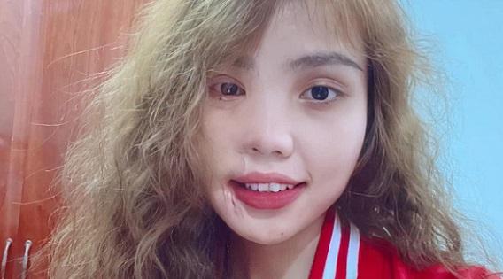 Cô gái bị tình cũ tạt axit nửa gương mặt cuốn hút trong bộ ảnh nghệ thuật