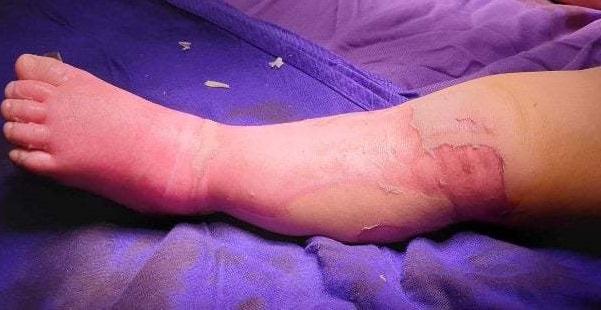 Bé trai 9 tháng tuổi tử vong vì đắp lá chữa bỏng nước sôi