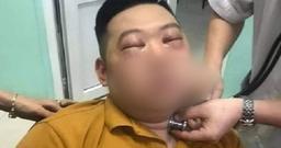 Sau khi thái hành, nam thanh niên bị sốc phản vệ nặng phải vào viện cấp cứu
