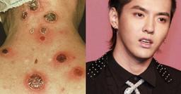 Bệnh giang mai mà Ngô Diệc Phàm bị đồn mắc phải nguy hiểm cỡ nào?