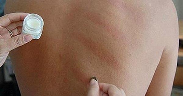 Người mắc Covid có nên cạo gió không?