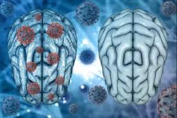 Nguyên GĐ BV Nhiệt đới TW: Covid-19 để lại 203 di chứng, 52% người gặp vấn đề về trí nhớ