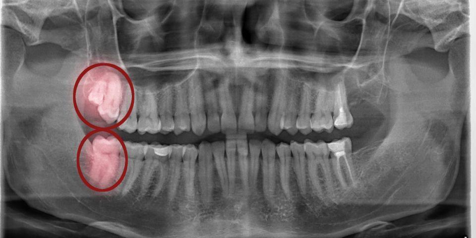 Vì sao mọc chỗ "ngu" lại gây đau đớn nhưng lại được gọi là "răng khôn"?
