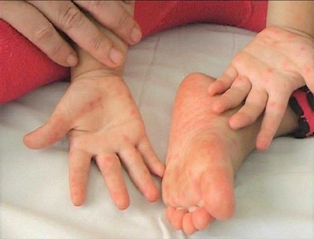 Bộ Y tế cảnh báo: 5.500 ca tay chân miệng, 1 trường hợp tử vong