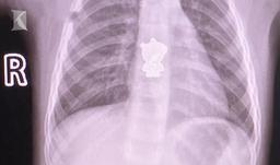 Bé gái ho ra máu vì nuốt phải hình dán heo Peppa