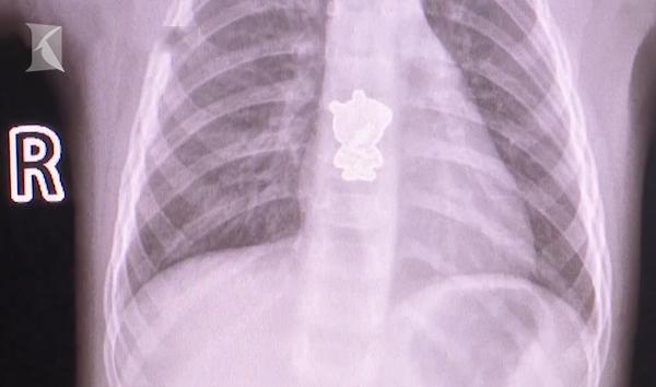 Bé gái ho ra máu vì nuốt phải hình dán heo Peppa