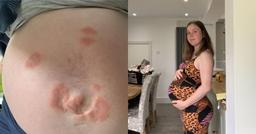 Người phụ nữ mắc bệnh dị ứng với đứa con của mình, cứ đứng gần là nổi mụn