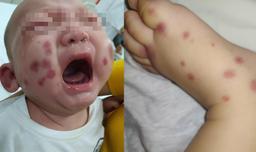 Việt Nam phát hiện và điều trị một ca bệnh cực hiếm, cả thế giới chỉ có 300-500 người.