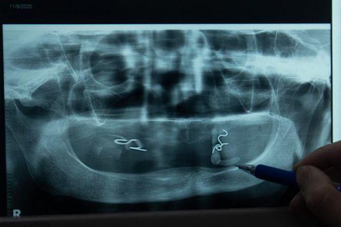 Hà Nội: Bệnh nhân mọc sỏi trong miệng