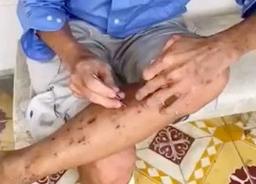 TP.HCM: Người đàn ông bị hoang tưởng nhiễm ký sinh trùng